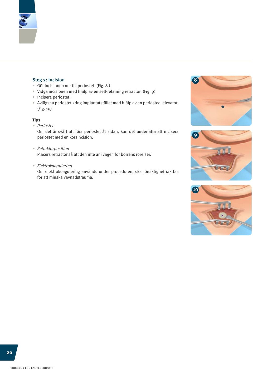 10) Tips Periostet Om det är svårt att föra periostet åt sidan, kan det underlätta att incisera periostet med en korsincision.