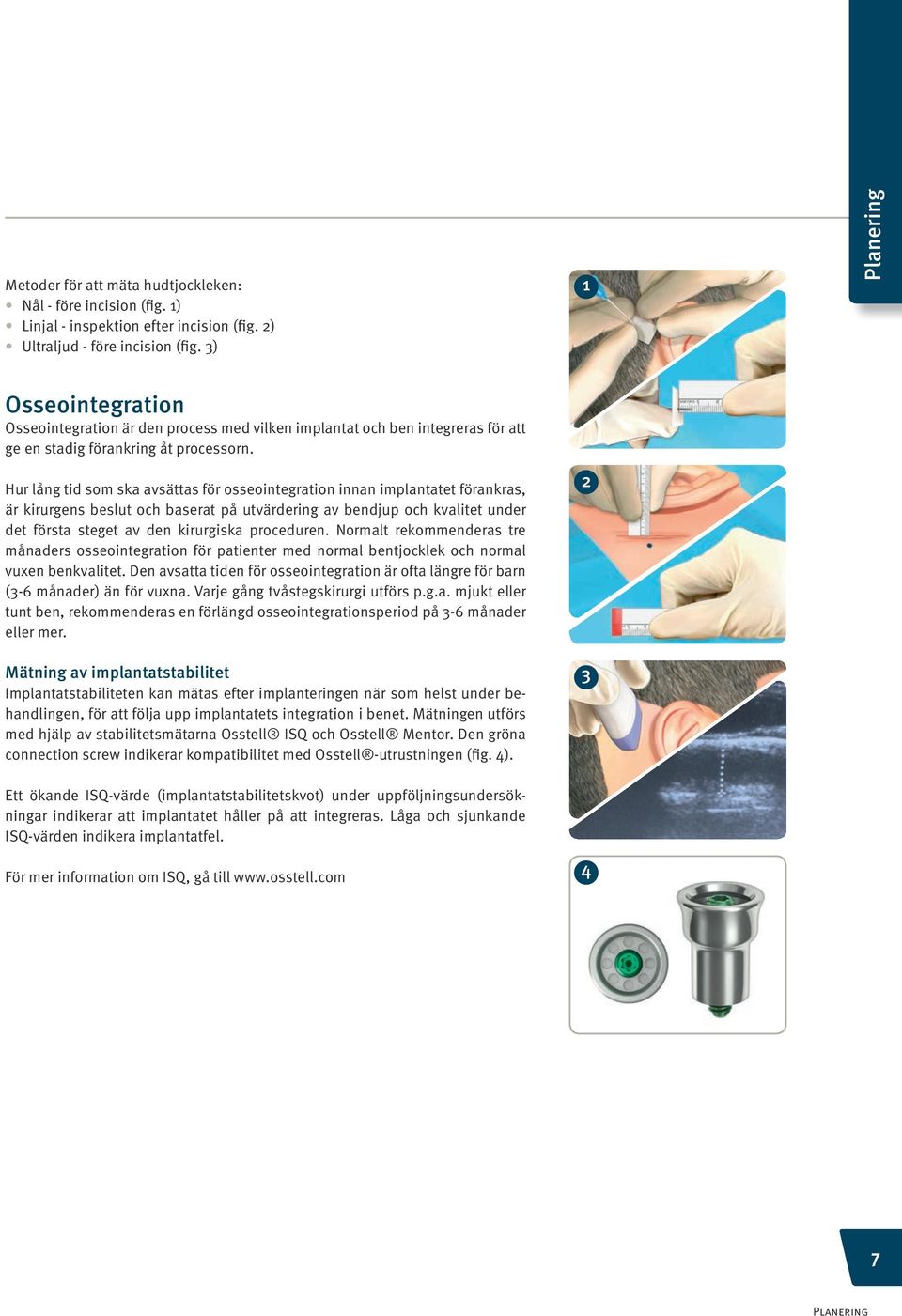 Hur lång tid som ska avsättas för osseointegration innan implantatet förankras, är kirurgens beslut och baserat på utvärdering av bendjup och kvalitet under det första steget av den kirurgiska