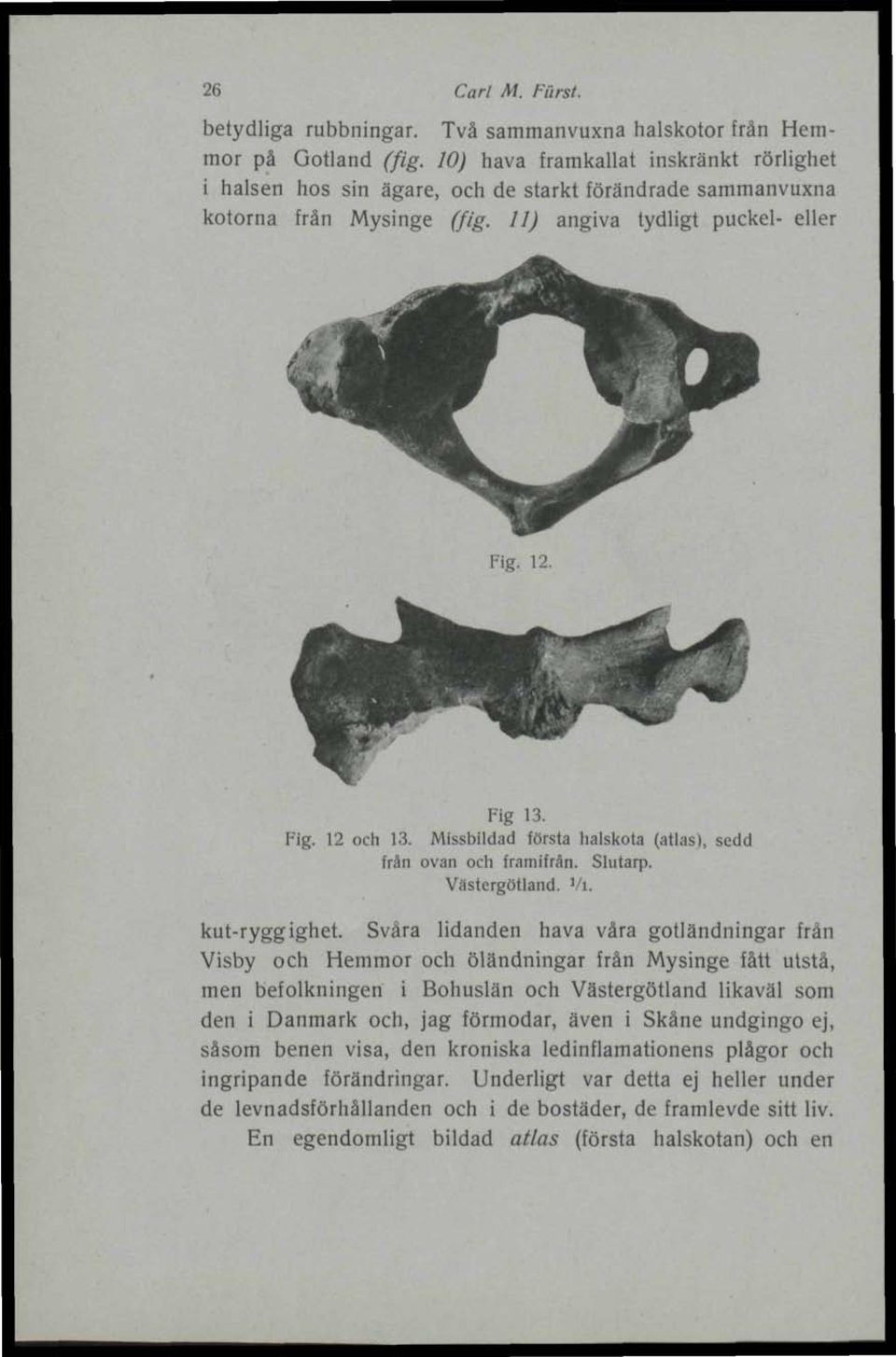 Missbildad första halskota (atlas), sedd frän ovan och framifrån. Slutarp. Västergötland. Vi. kut-ryggighet.