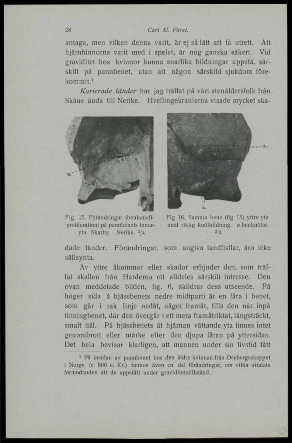 1 Karterade tänder har jag träffat på vårt stenåldersfolk från Skåne ända till Nerike. Hvellingekranierna visade mycket ska- --O. Fig. 15. Förändringar (benlamellproliferation) på pannbenets inneryta.