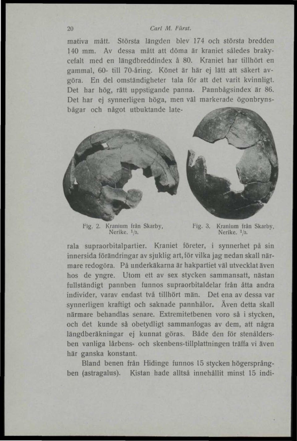 Pannbägsindex är 86. Det har ej synnerligen höga, men väl markerade ögonbrynsbågar och något utbuktande late- Fig. 2. Kranium frän Skarby, Nerike. ' ::. Fig. 3. Kranium frän Skarby, Nerike. ' :. rala supraorbitalpartier.