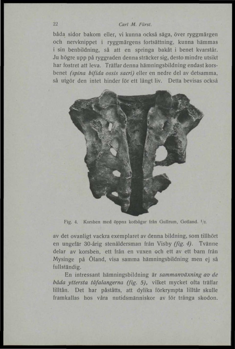 Träffar denna hämningsbildning endast korsbenet (splna bifida ossis sacri) eller en nedre del av detsamma, så utgör den intet hinder för ett långt liv. Detta bevisas också Fig. 4.