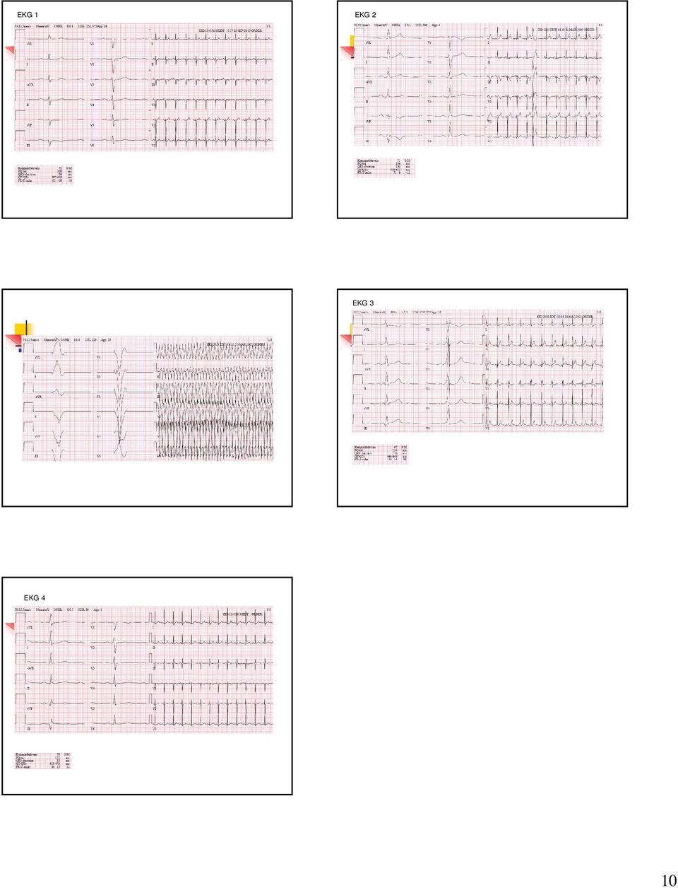 EKG 4 10