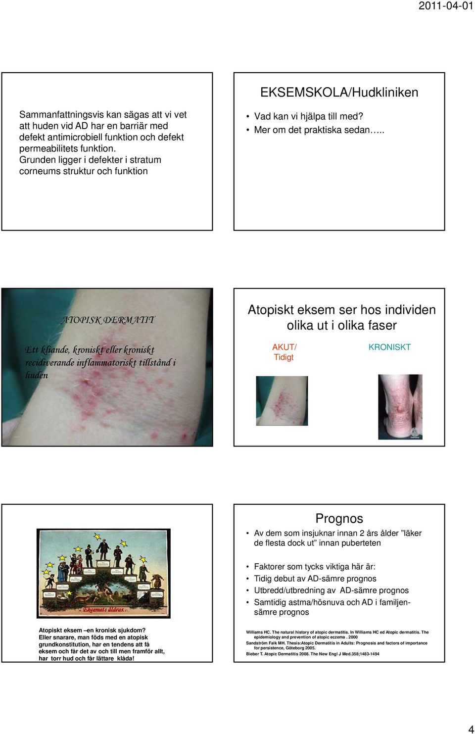 . ATOPISK DERMATIT Atopiskt eksem ser hos individen olika ut i olika faser Ett kliande, kroniskt eller kroniskt recidiverande inflammatoriskt tillstånd i huden AKUT/ Tidigt KRONISKT Prognos Av dem