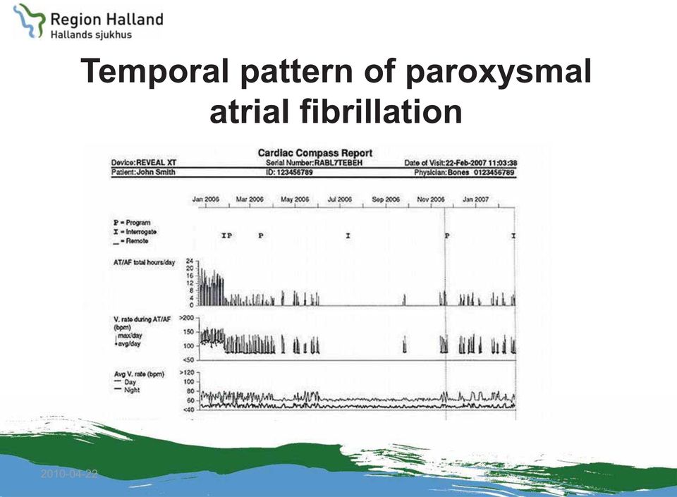 paroxysmal