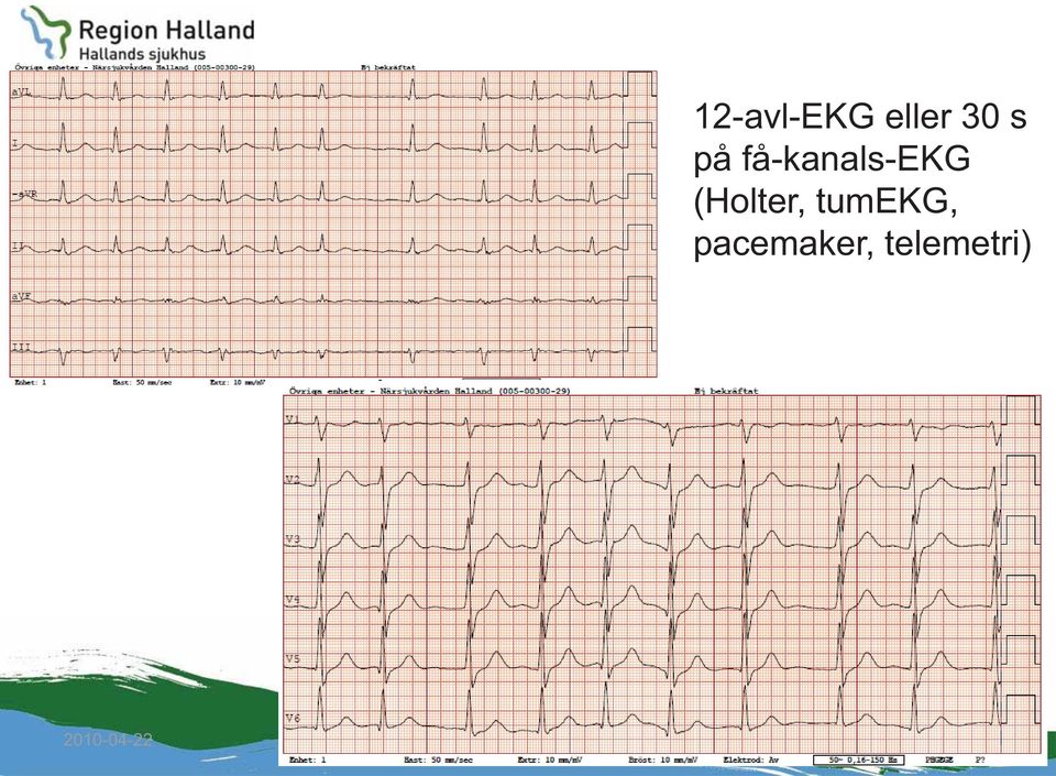 få-kanals-ekg