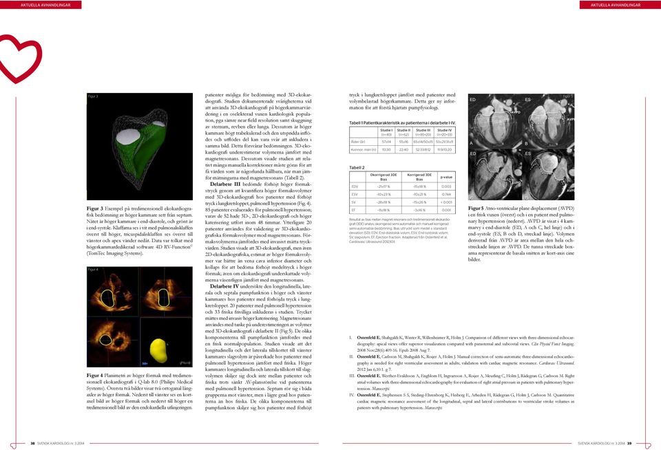 Data var tolkat med högerkammardedikerad software 4D RV-Function (TomTec Imaging Systems). Figur 4 Figur 4 Planimetri av höger förmak med tredimensionaell ekokardiografi i Q-lab 8.