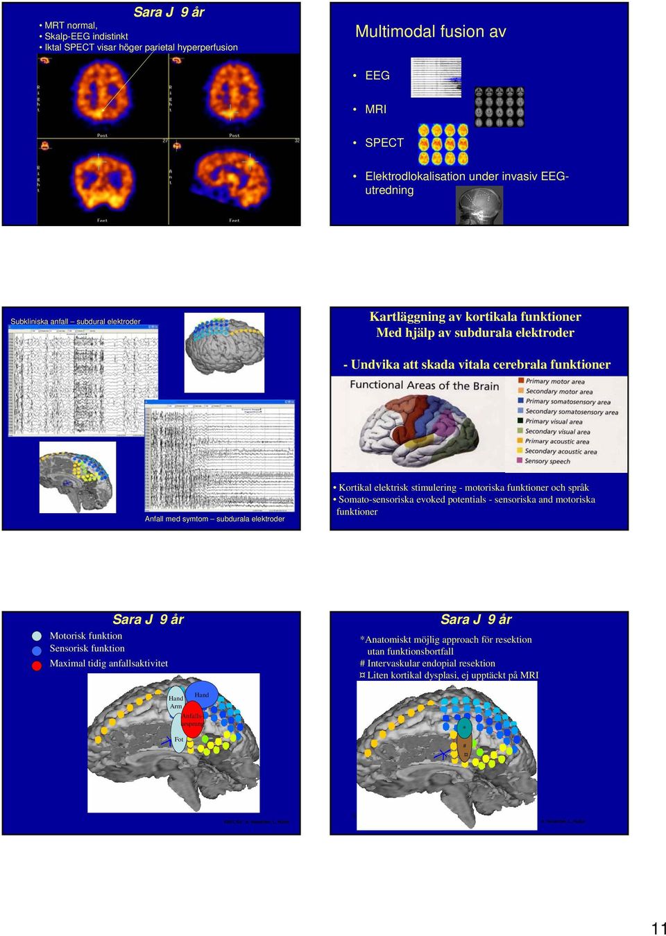 Somato-sensoriska evoked potentials - sensoriska and motoriska funktioner Sara J 9 år Motorisk funktion Sensorisk funktion Maximal tidig anfallsaktivitet Elektrodlokalisation under invasiv