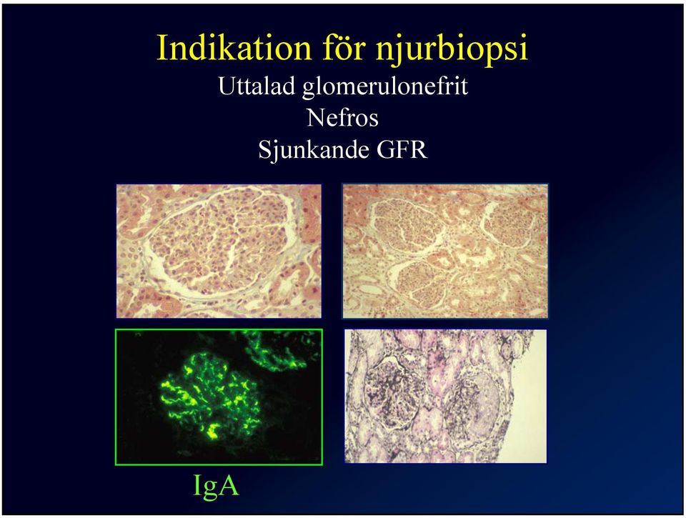 glomerulonefrit