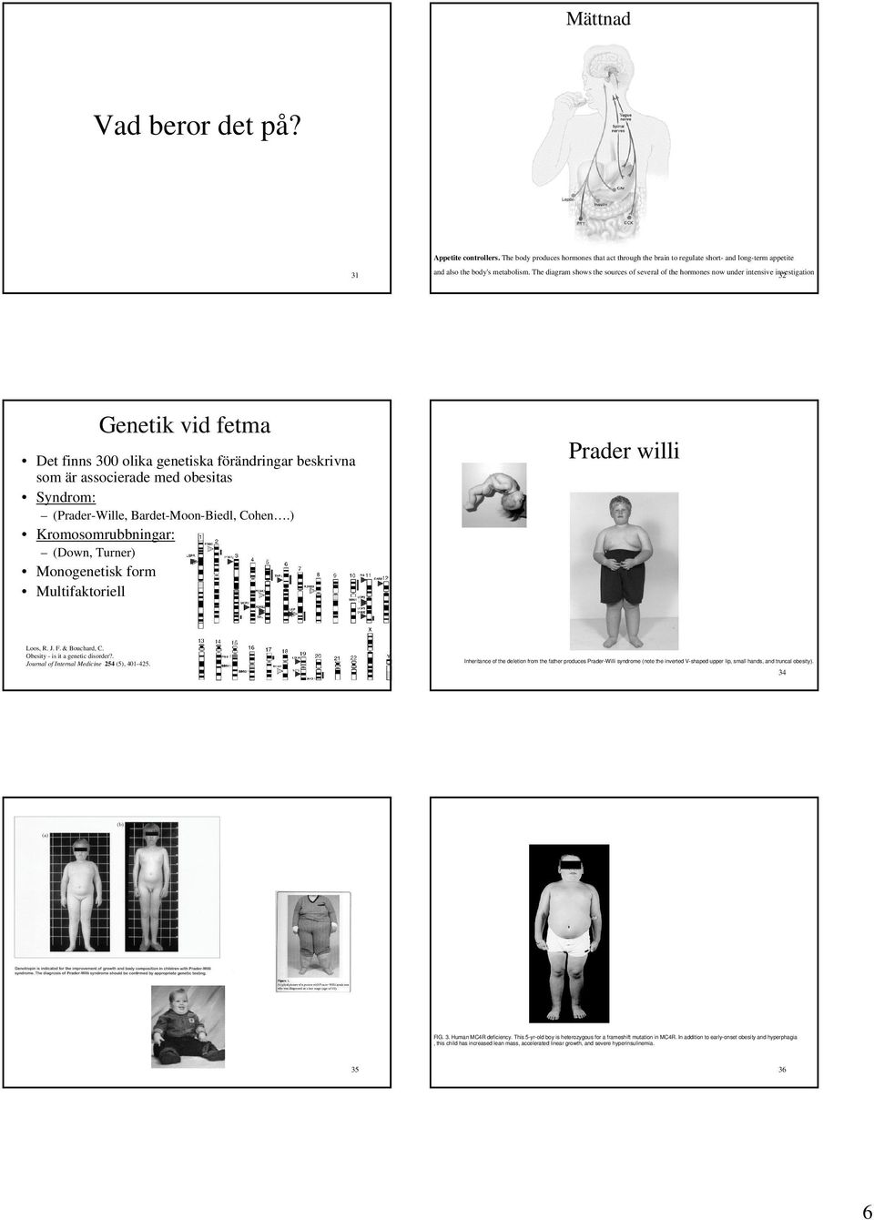 Syndrom: (Prader-Wille, Bardet-Moon-Biedl, Cohen.) Kromosomrubbningar: (Down, Turner) Monogenetisk form Multifaktoriell Prader willi Loos, R. J. F. & Bouchard, C. Obesity - is it a genetic disorder?