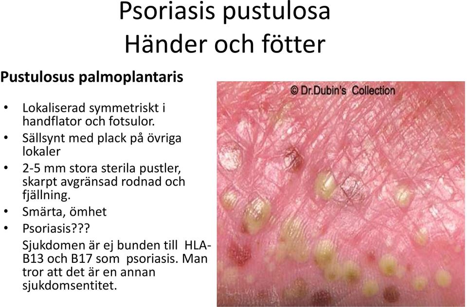 rodnad och fjällning. Smärta, ömhet Psoriasis?