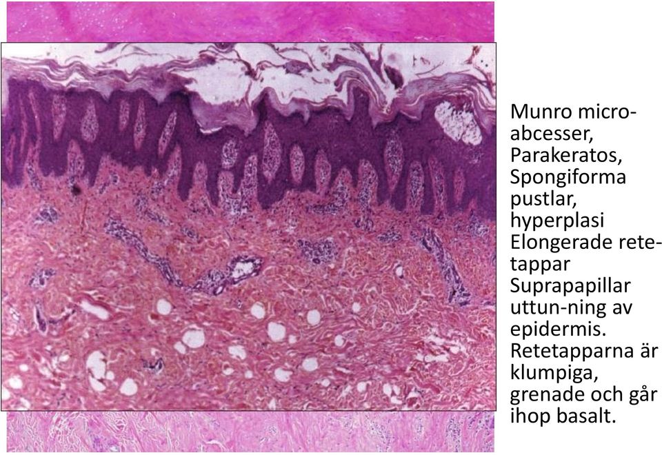 retetappar Suprapapillar uttun-ning av epidermis.