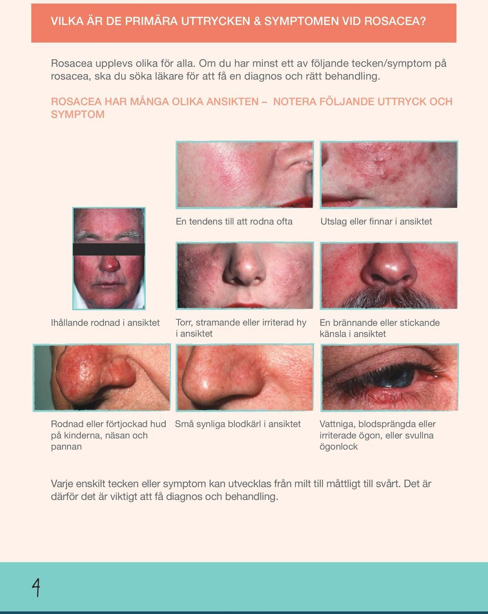 ROSACEA HAR MÅNGA OLIKA ANSIKTEN NOTERA FÖLJANDE UTTRYCK OCH SYMPTOM En tendens till att rodna ofta Utslag eller finnar i ansiktet Ihållande rodnad i ansiktet Torr, stramande eller irriterad