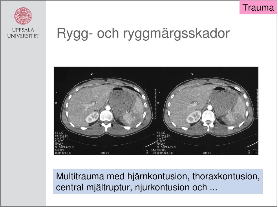 hjärnkontusion,