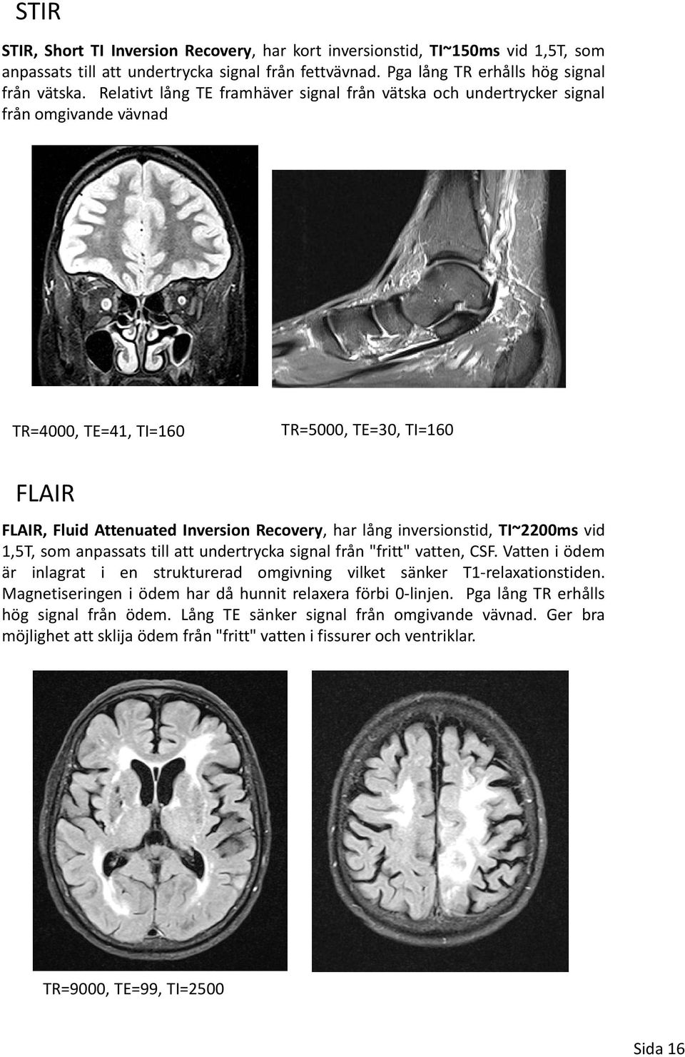 inversionstid, TI~2200ms vid 1,5T, som anpassats till att undertrycka signal från "fritt" vatten, CSF. Vatten i ödem är inlagrat i en strukturerad omgivning vilket sänker T1 relaxationstiden.