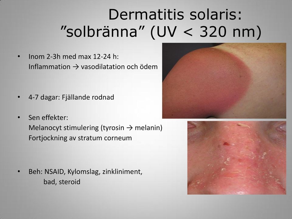 Sen effekter: Melanocyt stimulering (tyrosin melanin) Fortjockning