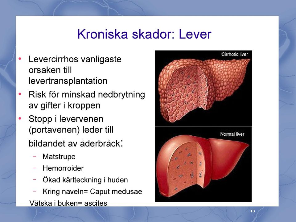 Stopp i levervenen (portavenen) leder till bildandet av åderbråck: