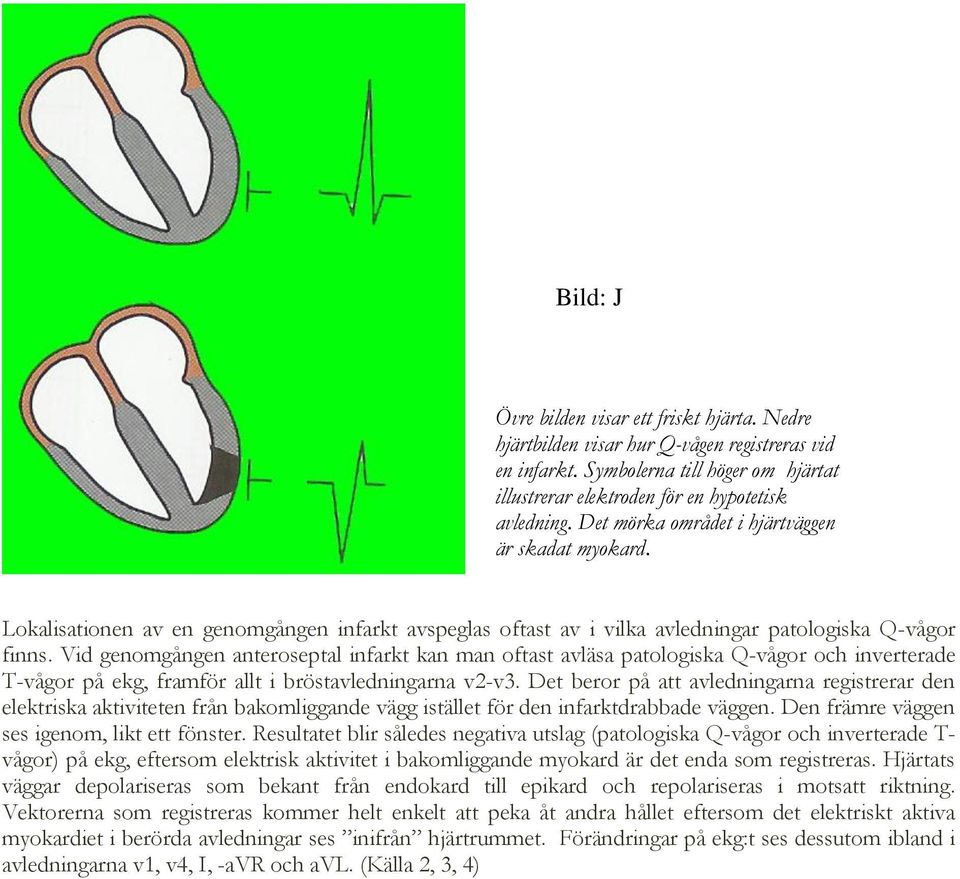 Vid genomgången anteroseptal infarkt kan man oftast avläsa patologiska Q-vågor och inverterade T-vågor på ekg, framför allt i bröstavledningarna v2-v3.