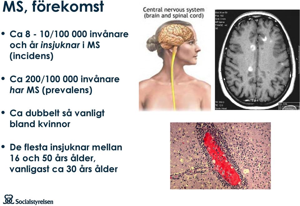 (prevalens) Ca dubbelt så vanligt bland kvinnor De