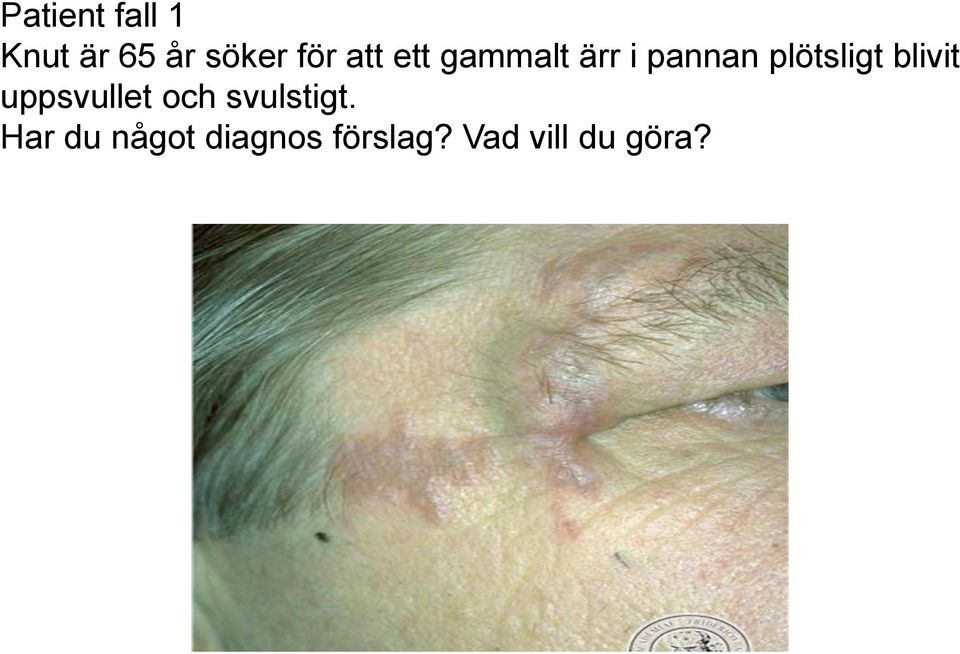 blivit uppsvullet och svulstigt.