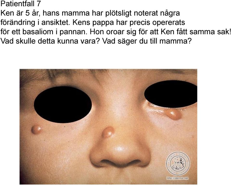 Kens pappa har precis opererats för ett basaliom i pannan.