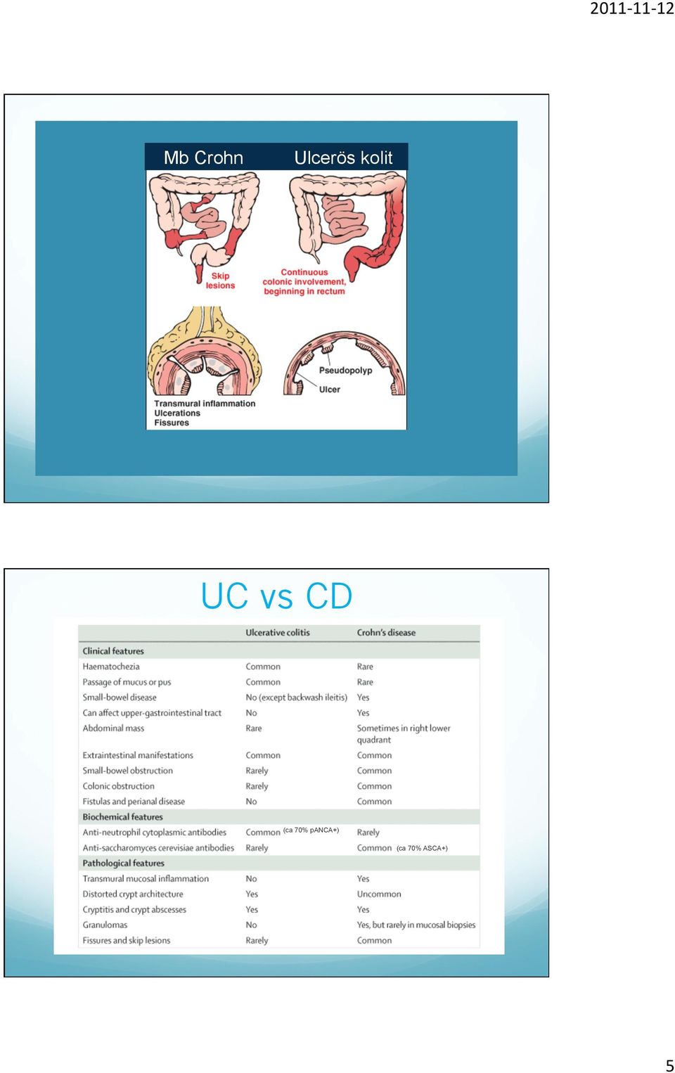 UC vs CD (ca