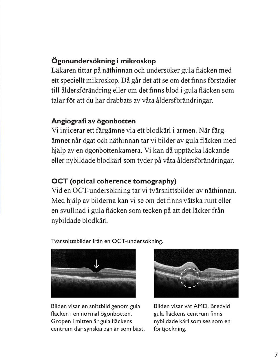 Angiografi av ögonbotten Vi injicerar ett färgämne via ett blodkärl i armen. När färgämnet når ögat och näthinnan tar vi bilder av gula fläcken med hjälp av en ögonbottenkamera.