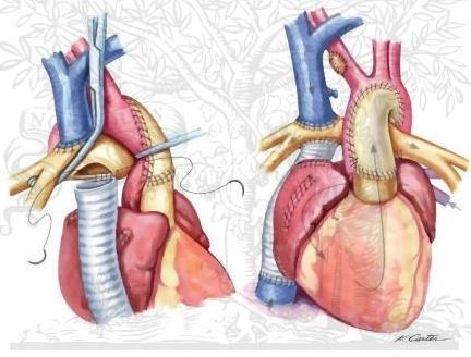 inför Glenn Antikoagulation livslångt Bild från: http://www.