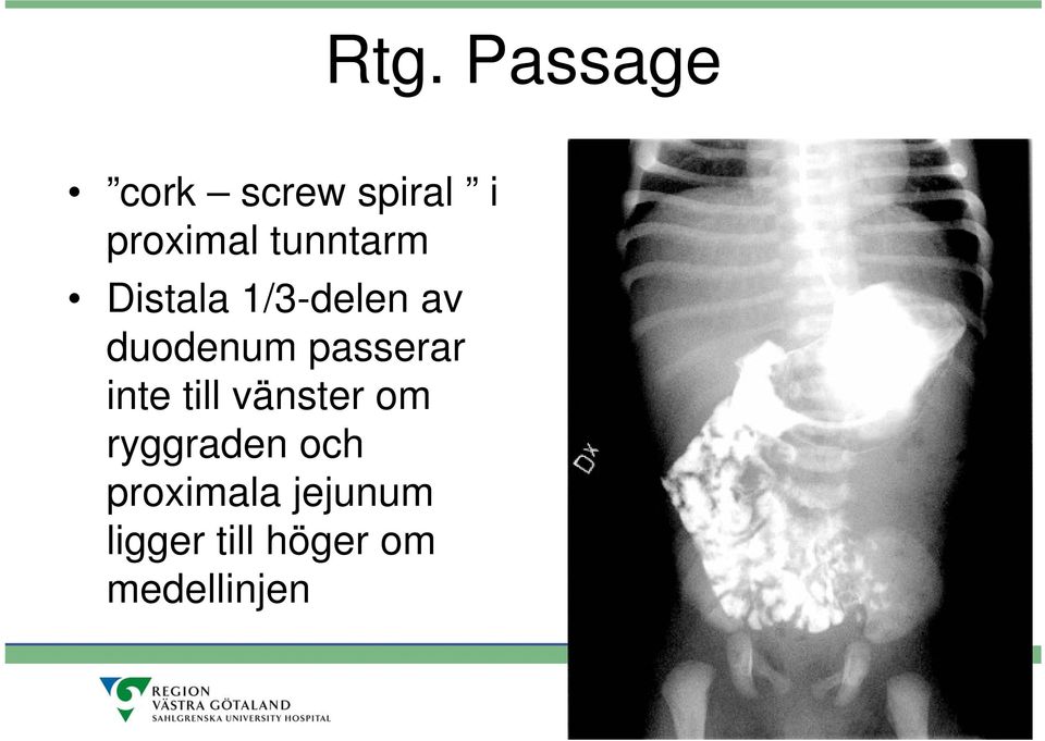 passerar inte till vänster om ryggraden och