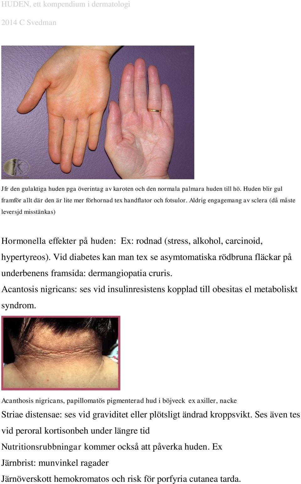 Vid diabetes kan man tex se asymtomatiska rödbruna fläckar på underbenens framsida: dermangiopatia cruris. Acantosis nigricans: ses vid insulinresistens kopplad till obesitas el metaboliskt syndrom.