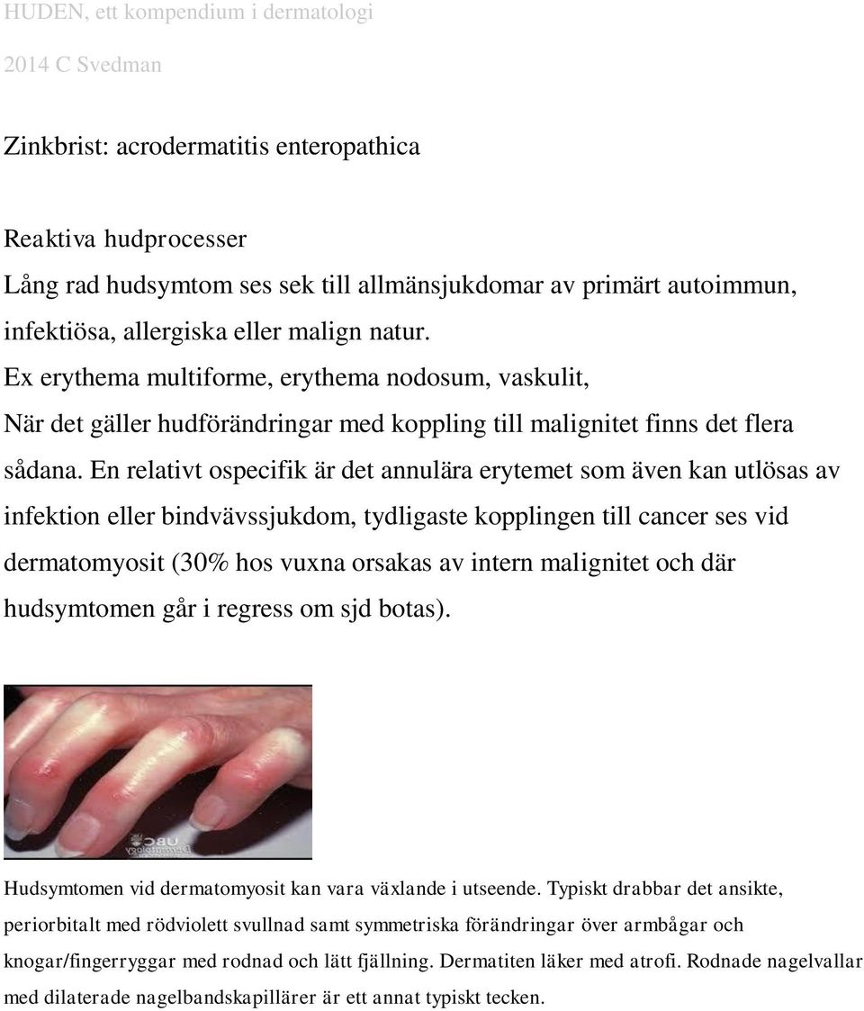 En relativt ospecifik är det annulära erytemet som även kan utlösas av infektion eller bindvävssjukdom, tydligaste kopplingen till cancer ses vid dermatomyosit (30% hos vuxna orsakas av intern