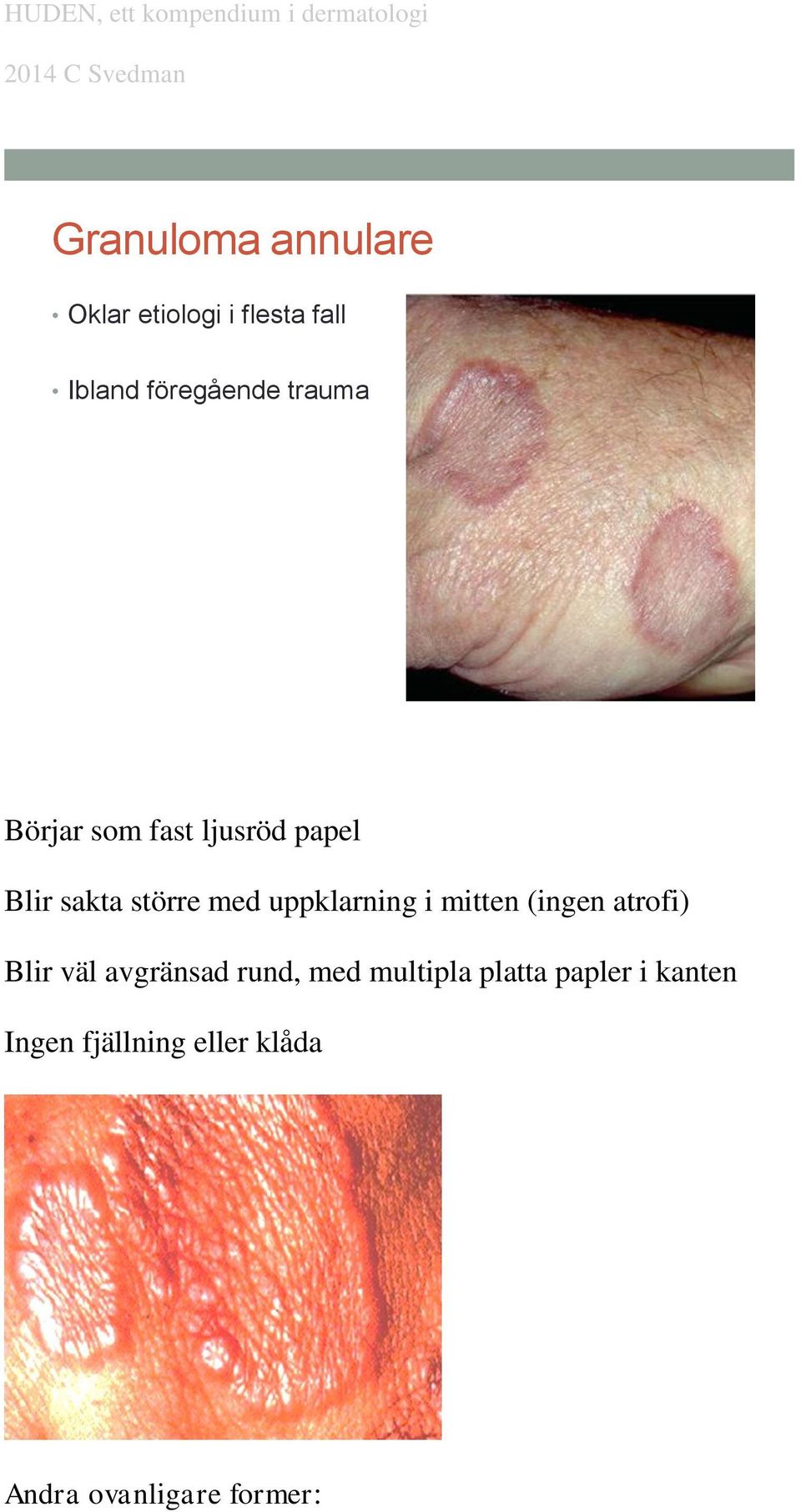 uppklarning i mitten (ingen atrofi) Blir väl avgränsad rund, med