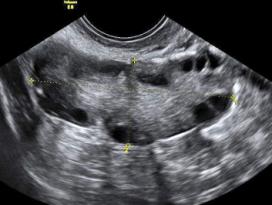 Embryology Classification ESHRE/ESGE consensus on the classification of female genital tract congenital anomalies: Grimbizis GF, Human Reprod 2013 a/ Two separate uterine, cervical, and vaginal