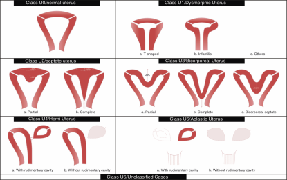 , JMRI41:1 12 (2015) Class U2: internal indentation > 50% of wall thickness and external contour straight /indentation <50%, Class U3: external indentation > 50% of the uterine wall thickness, Class