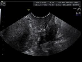 with solid component Sasauge shaped with papillary projections Peritoneal cysts Urinblåsan Follows pelvic walls Fixed Ovary/Tube trapped in the webb Normal