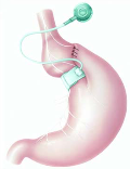 Gastric bypass Gastric sleeve 2000 Gagner et al.