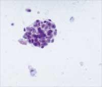 diagnos Finnålsbiopsi för cytologisk diagnos.