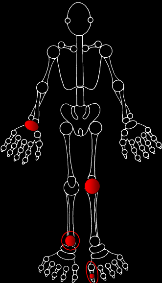 Subakut/smygande oligo/polyartrit Symmetrisk Asymmetrisk RA Psoriasisartrit Systemic lupus erythematosus (SLE)