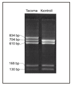 Hb Tacoma med PCR-RFLP I β-globinkedjan: arginin serin, aminosyraposition 30 1612 bp stort fragment