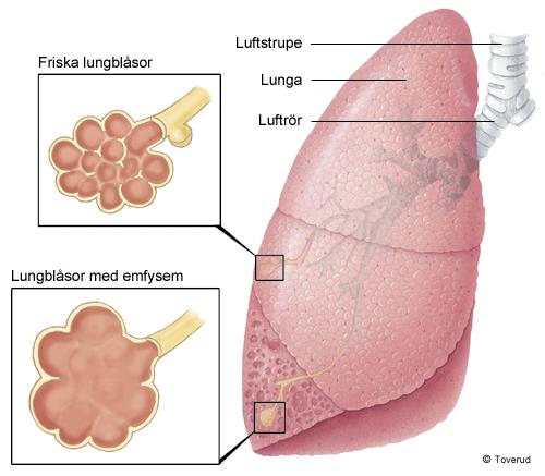 Vad händer med lungorna vid KOL? När lungblåsorna väggar förstörs fungerar inte längre gasutbytet mellan luft och blod. Detta kallas emfysem.