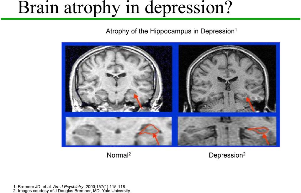 Depression 2 1. Bremner JD, et al. Am J Psychiatry.