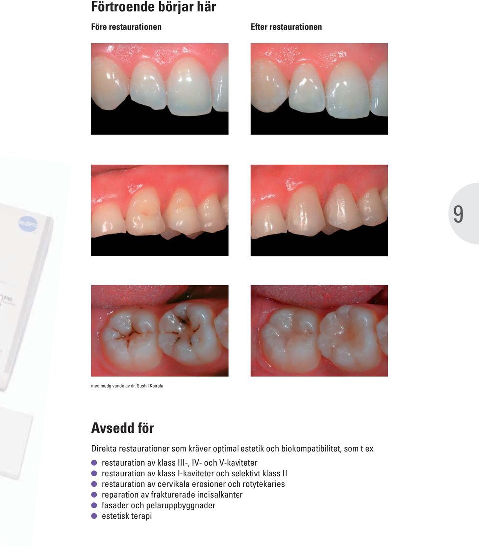 restauration av klass III-, IV- och V-kaviteter restauration av klass I-kaviteter och selektivt klass II
