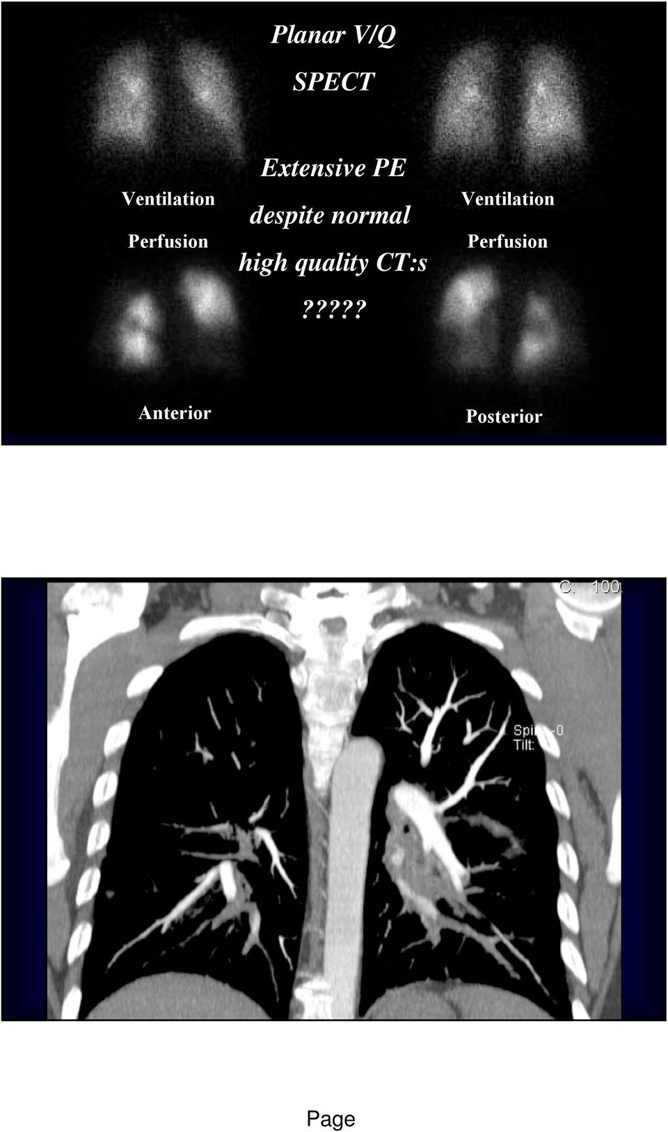 Extensive PE despite normal high