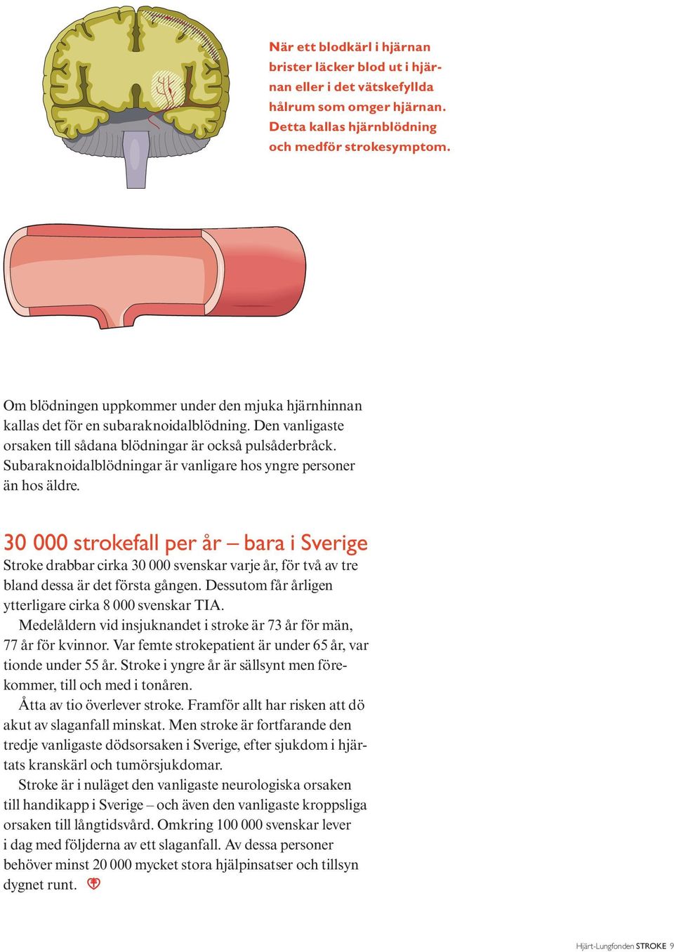 Subaraknoidalblödningar är vanligare hos yngre personer än hos äldre.