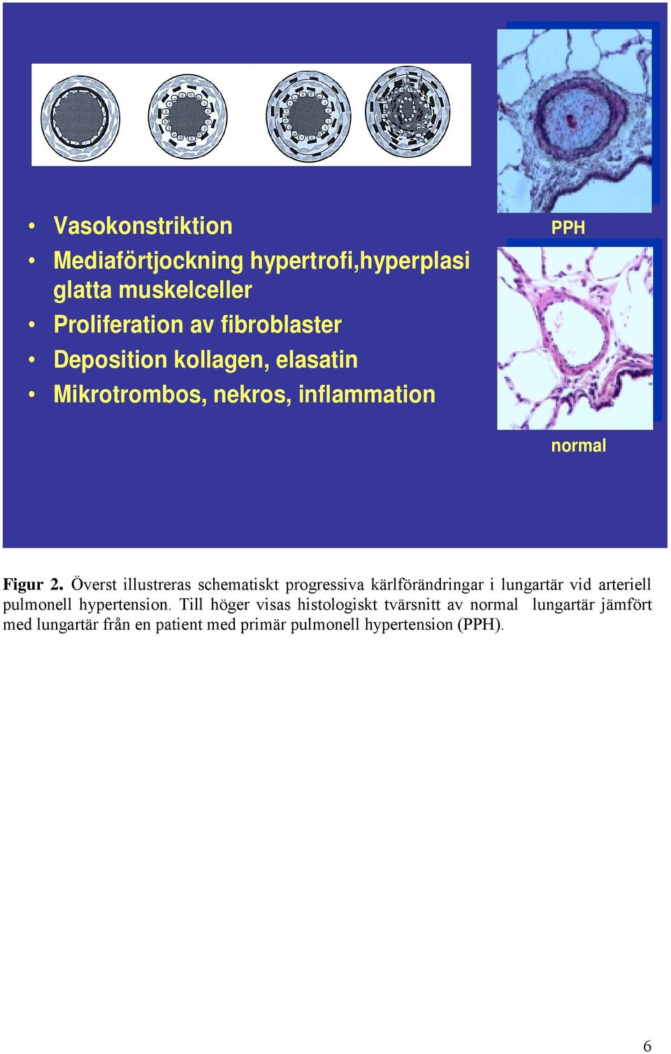 Överst illustreras schematiskt progressiva kärlförändringar i lungartär vid arteriell pulmonell hypertension.