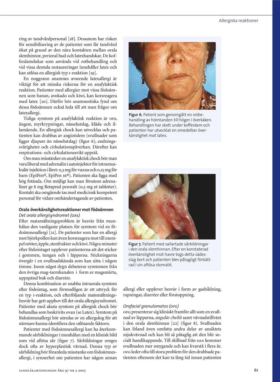 De kofferdamdukar som används vid rotbehandling och vid vissa dentala restaureringar innehåller latex och kan utlösa en allergisk typ i-reaktion [19].