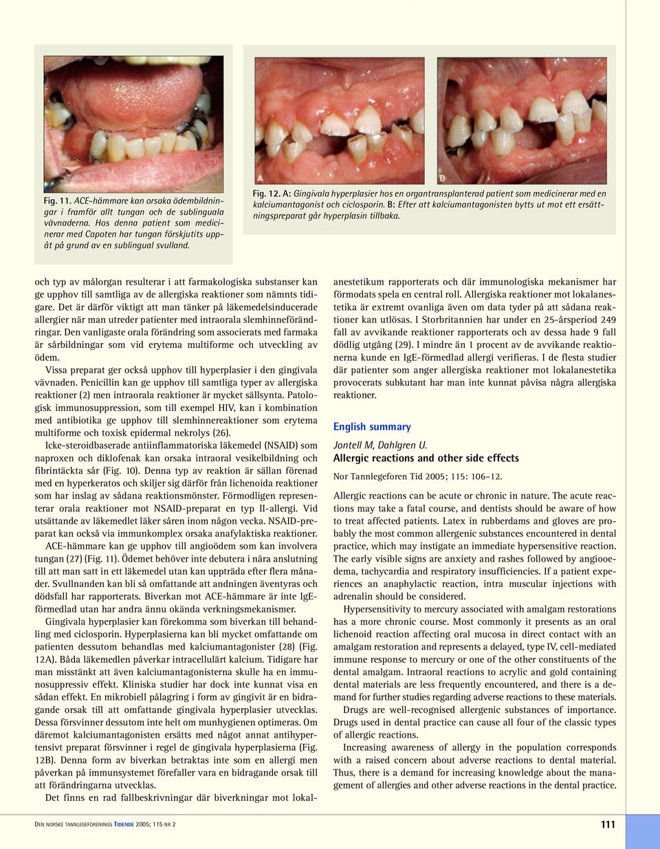 A: Gingivala hyperplasier hos en organtransplanterad patient som medicinerar med en kalciumantagonist och ciclosporin.