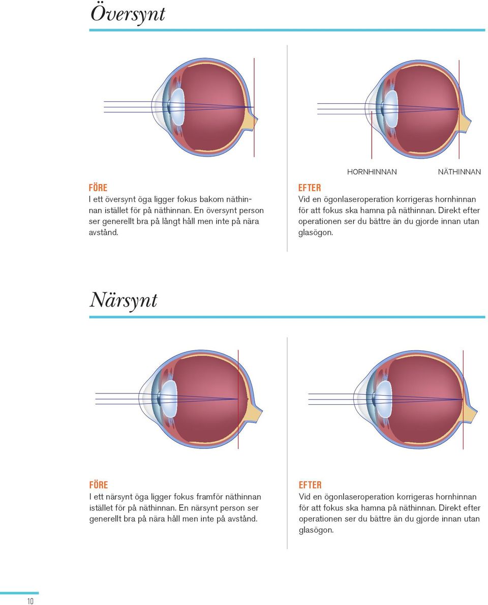 Direkt efter operationen ser du bättre än du gjorde innan utan glasögon. Närsynt FÖRE I ett närsynt öga ligger fokus framför näthinnan istället för på näthinnan.