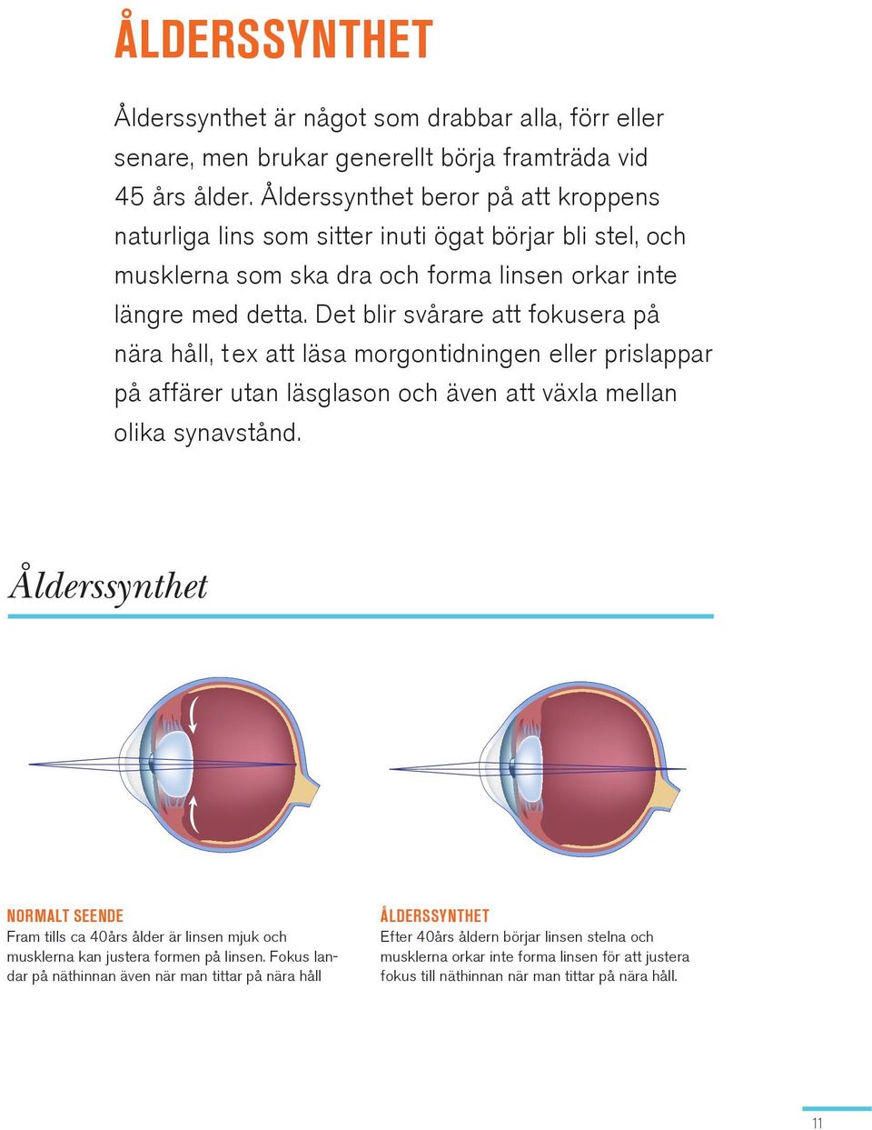 Det blir svårare att fokusera på nära håll, t ex att läsa morgontidningen eller prislappar på affärer utan läsglason och även att växla mellan olika synavstånd.