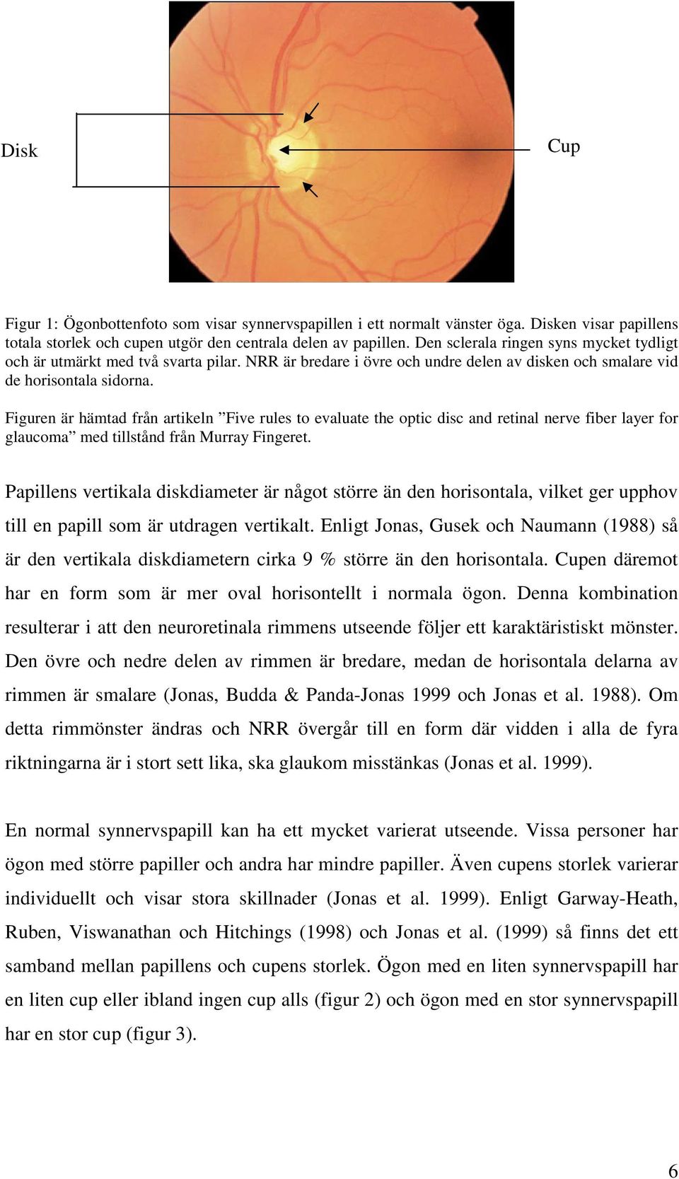 Figuren är hämtad från artikeln Five rules to evaluate the optic disc and retinal nerve fiber layer for glaucoma med tillstånd från Murray Fingeret.